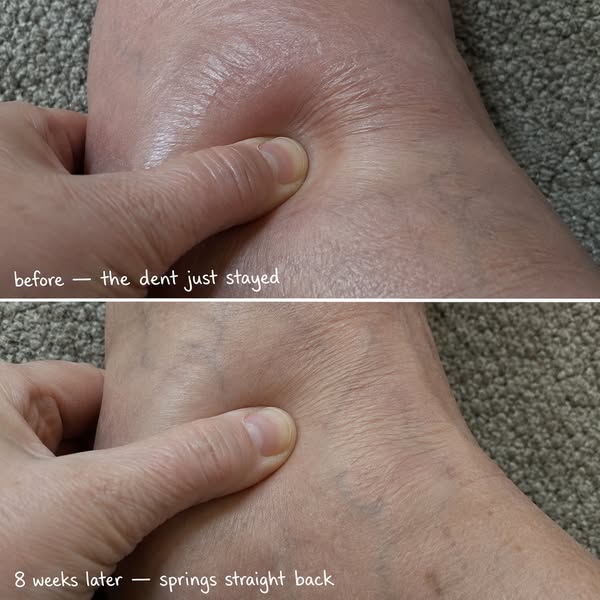 6 Years of Swollen Legs gone in 6 weeks