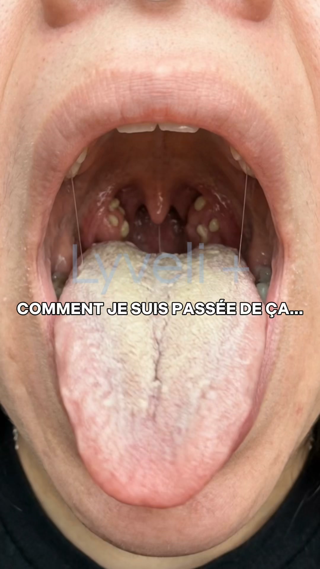 La solution naturelle contre l'halitose, la langue blanche et le casèum !