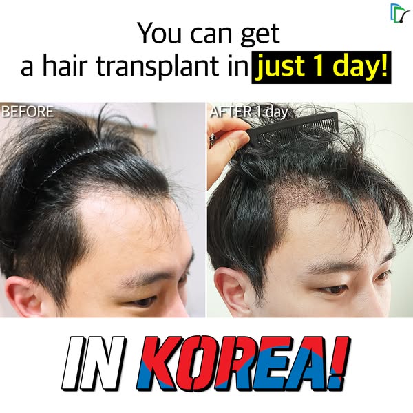 You can get a hair transplant in "just 1 day"