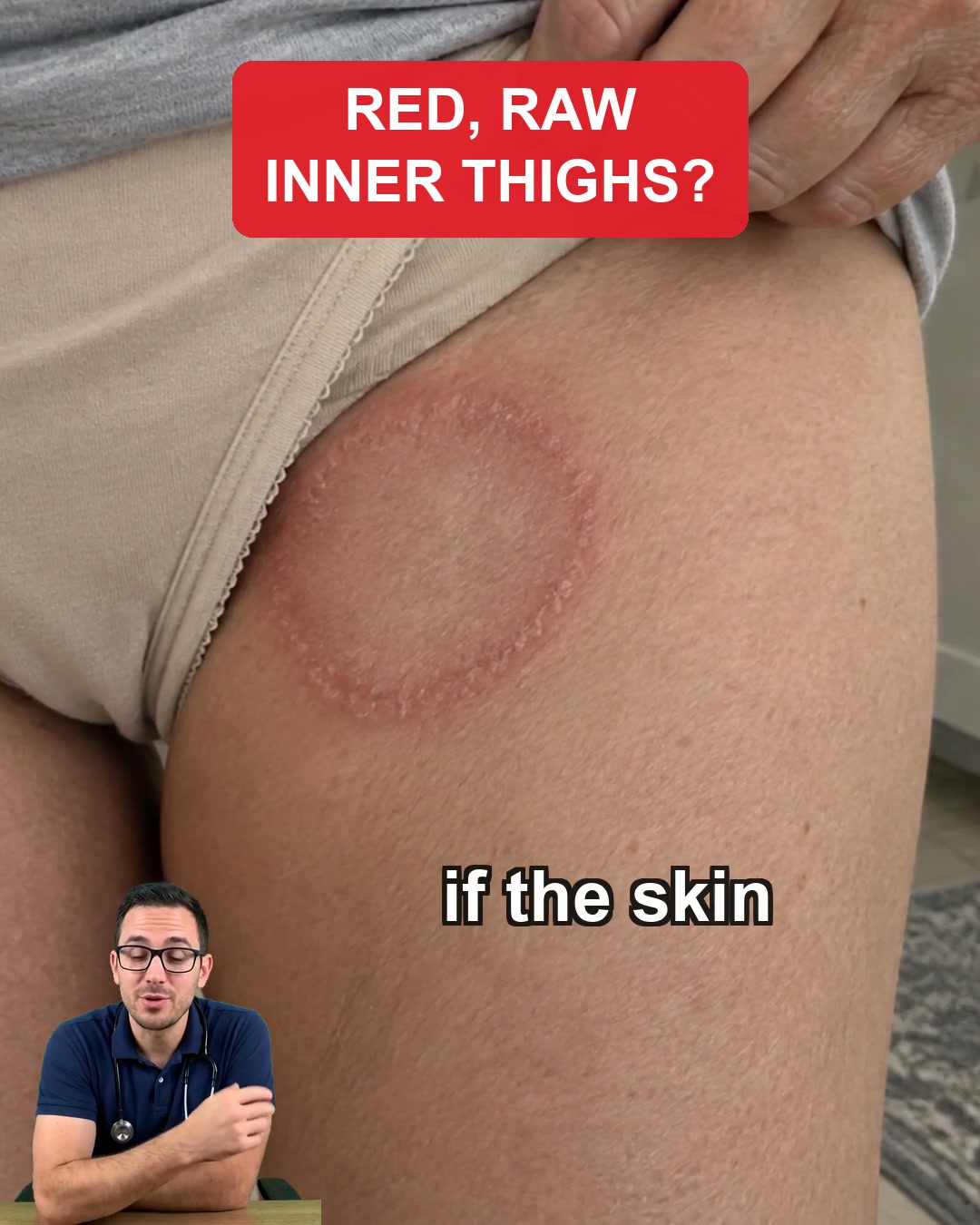 Rash Between Your Thighs? Calm The Itch In 60 Seconds