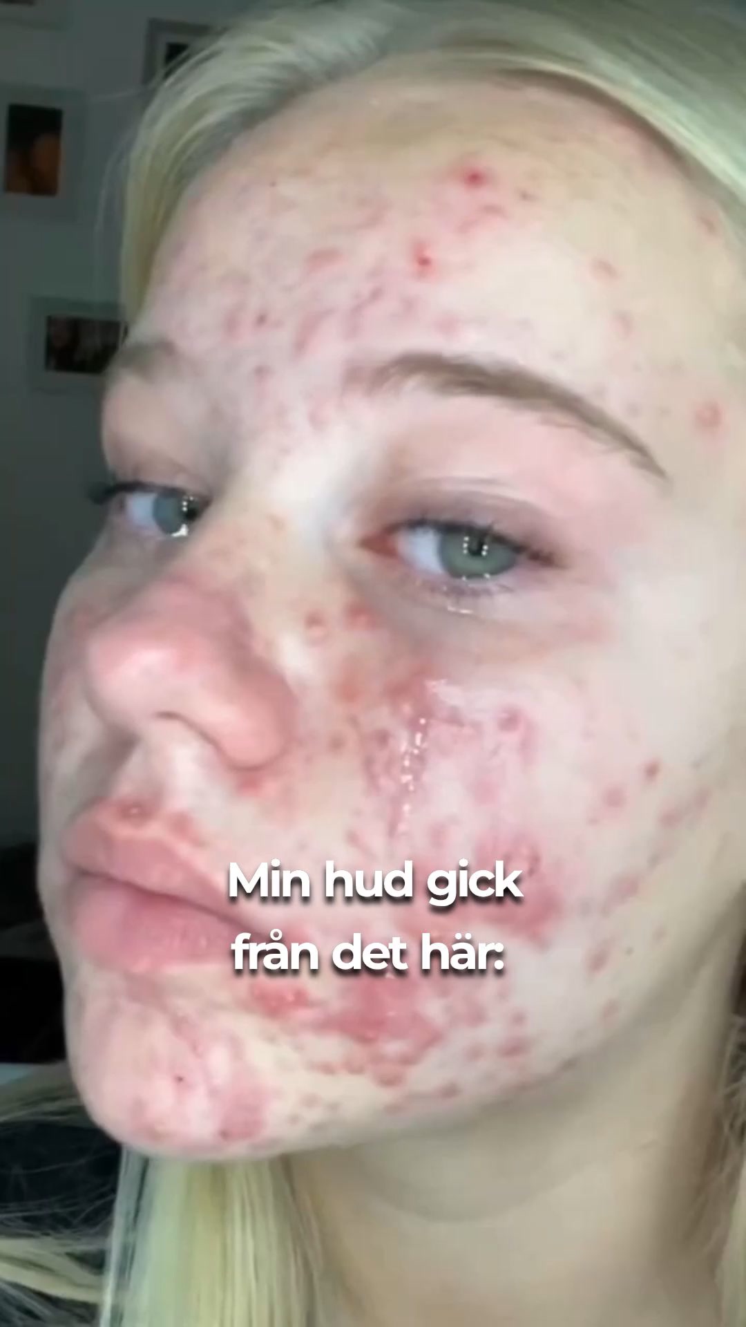 Slät hud på 3 veckor