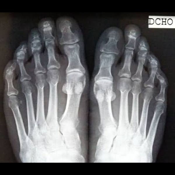 Don't Another $$ On Nail Fungus Treatments