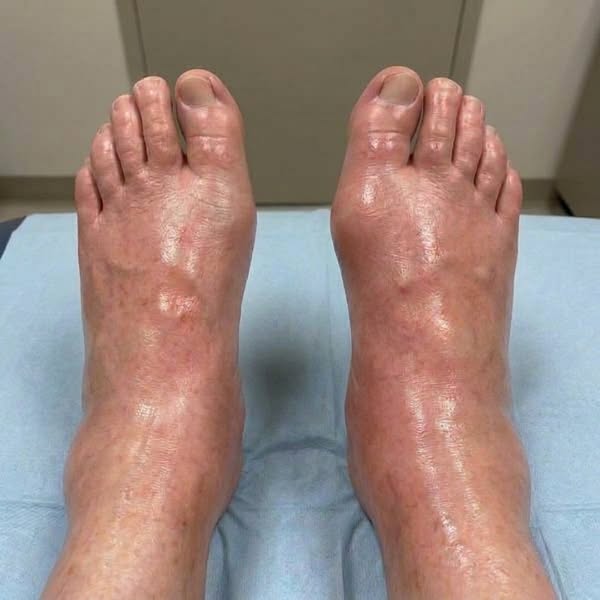 "5 years of my oedema swelling gone in 1 month?"