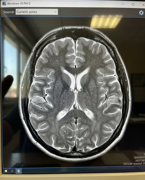 Il #1 antiossidante per cervello e memoria