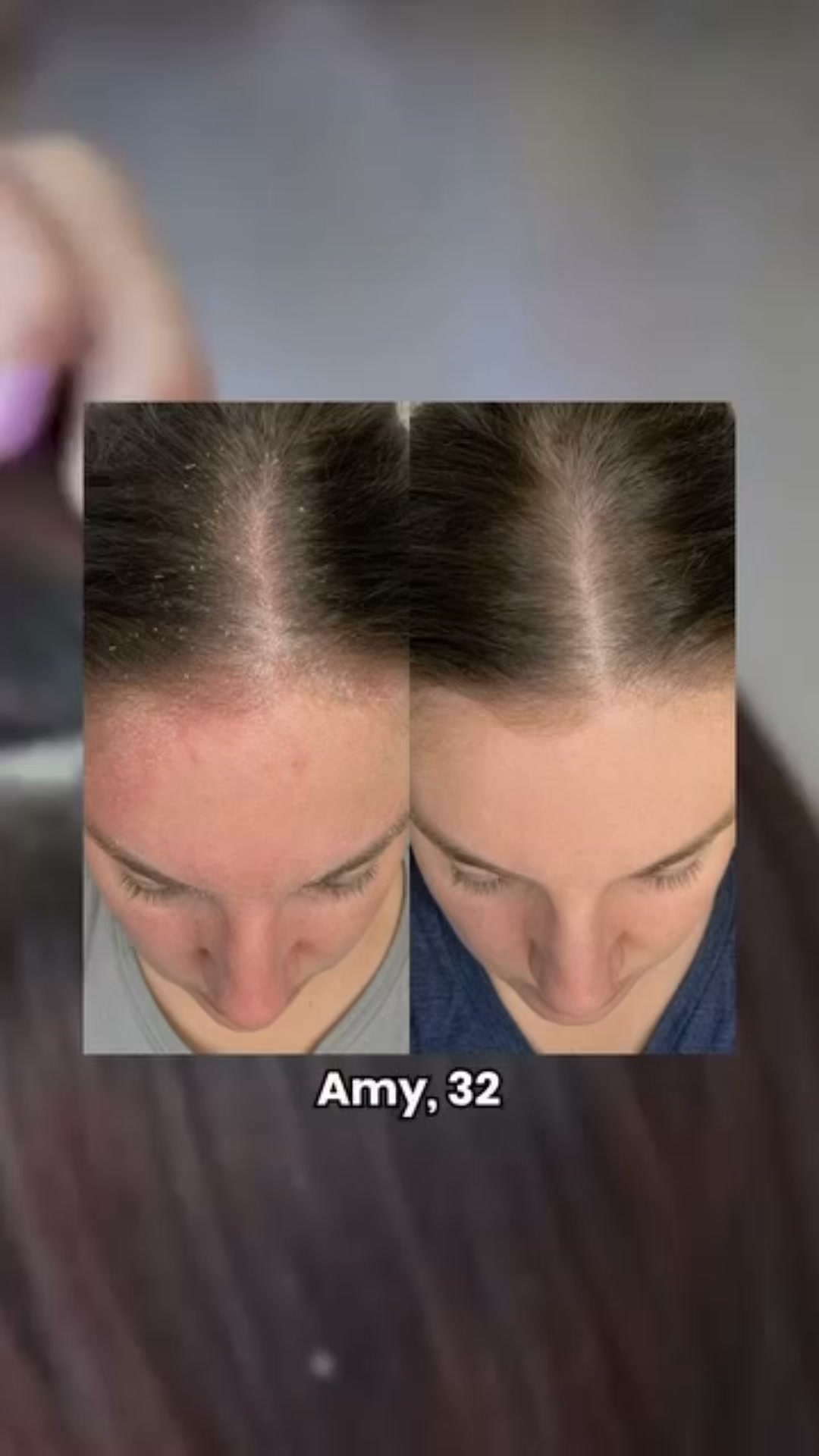 Calm Flaky Skin & Scalp Naturally