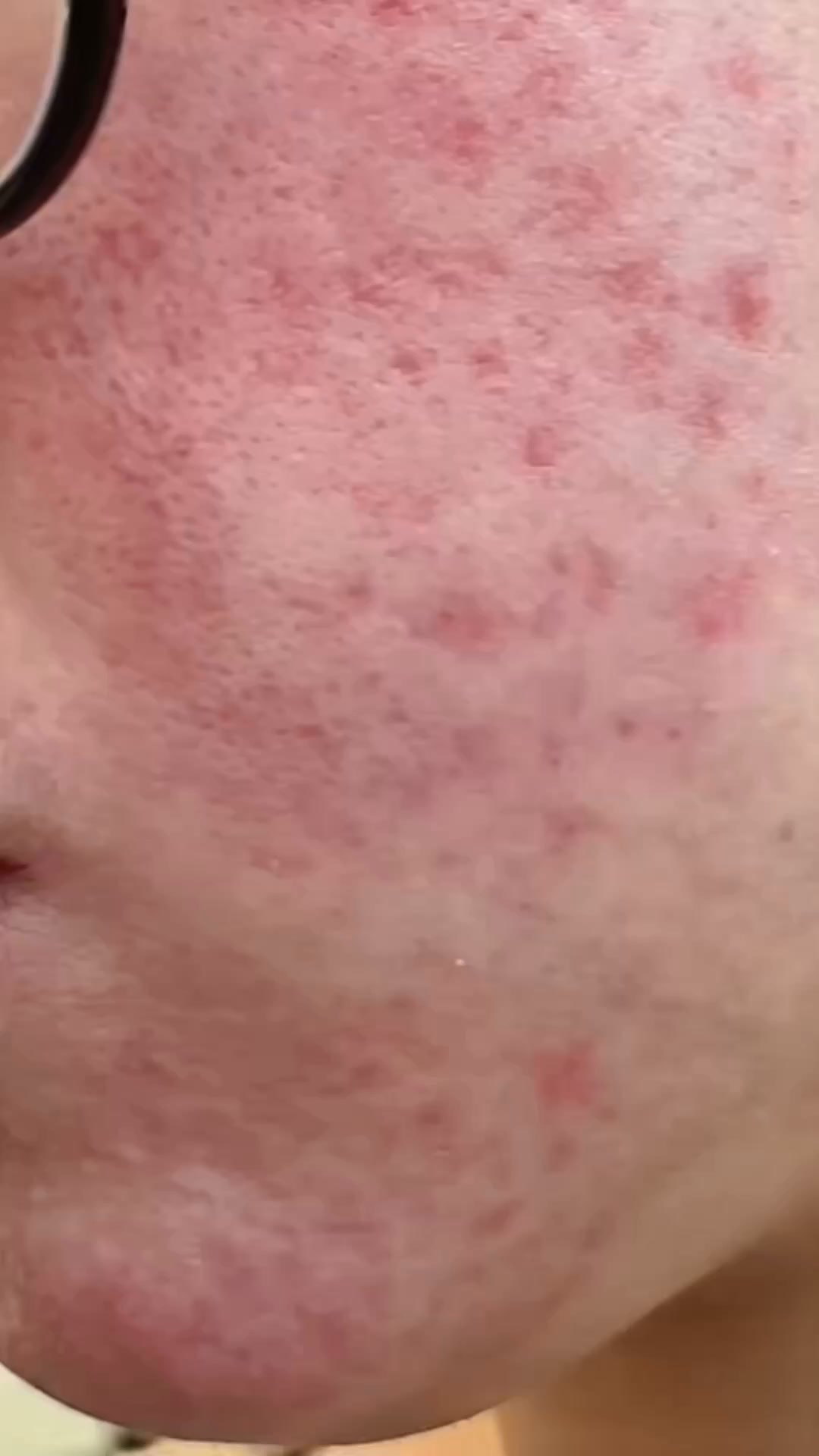 Book a Rosacea Assessment