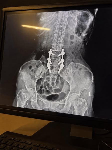 What they don't fell you about spinal stenosis...