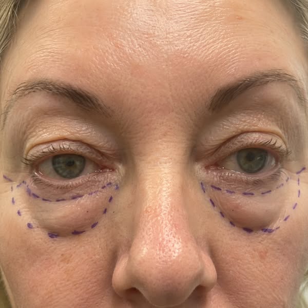Ojeras fuera en días