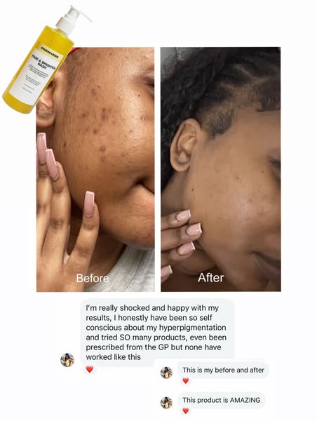Clear your Dark spots & Hyperpigmentaion within days!