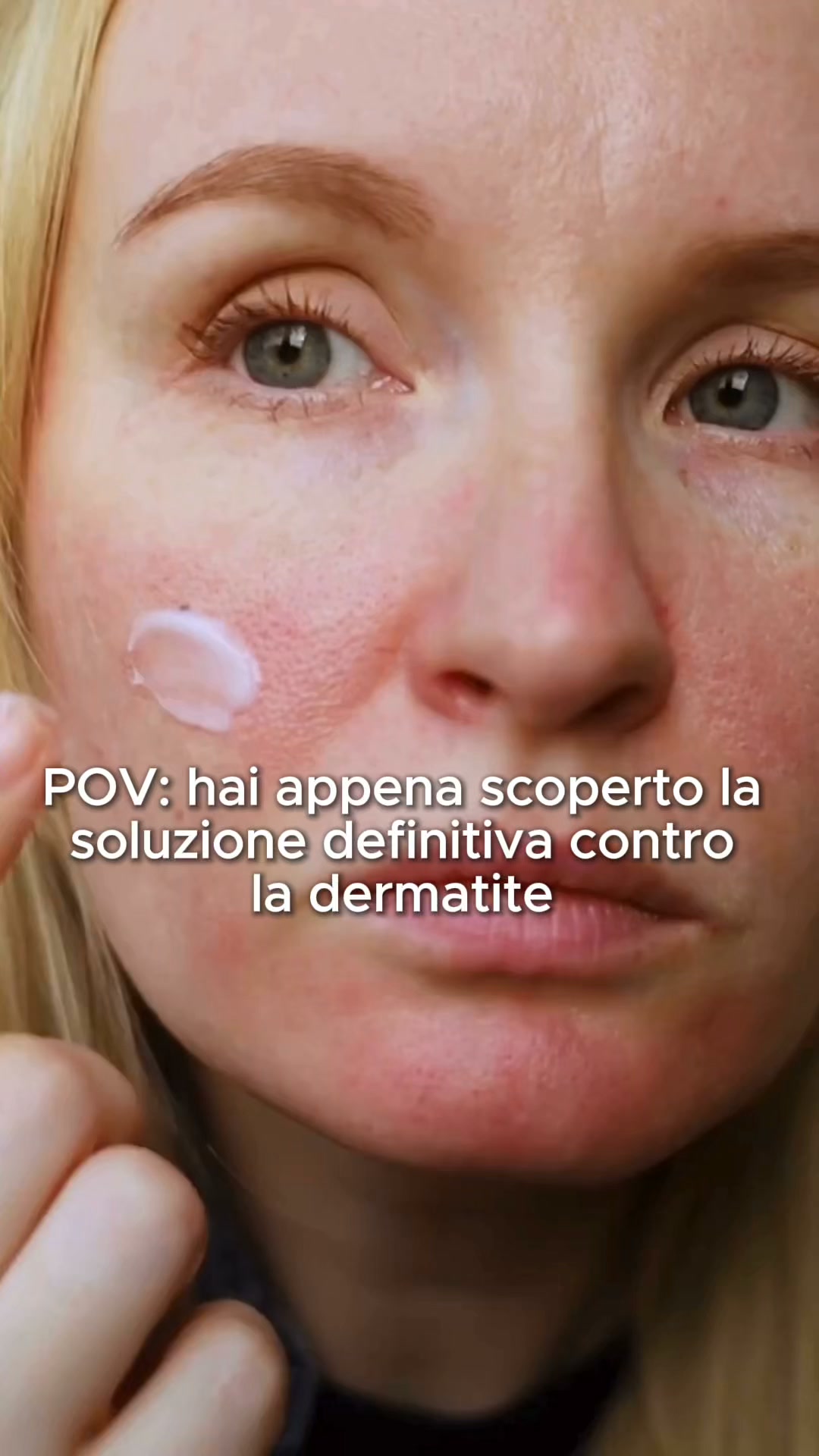 Contrasta finalmente la dermatite