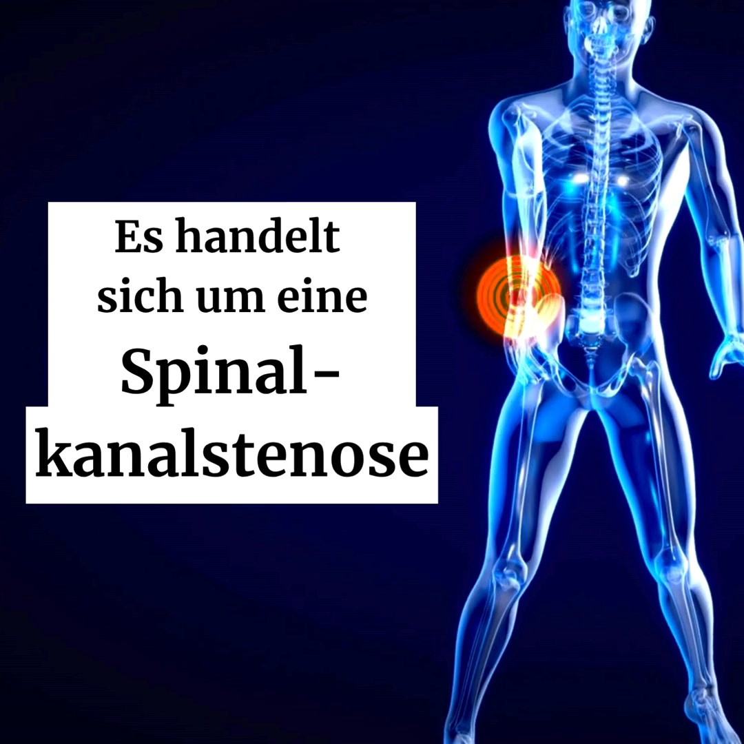 Spinalkanalstenose?
