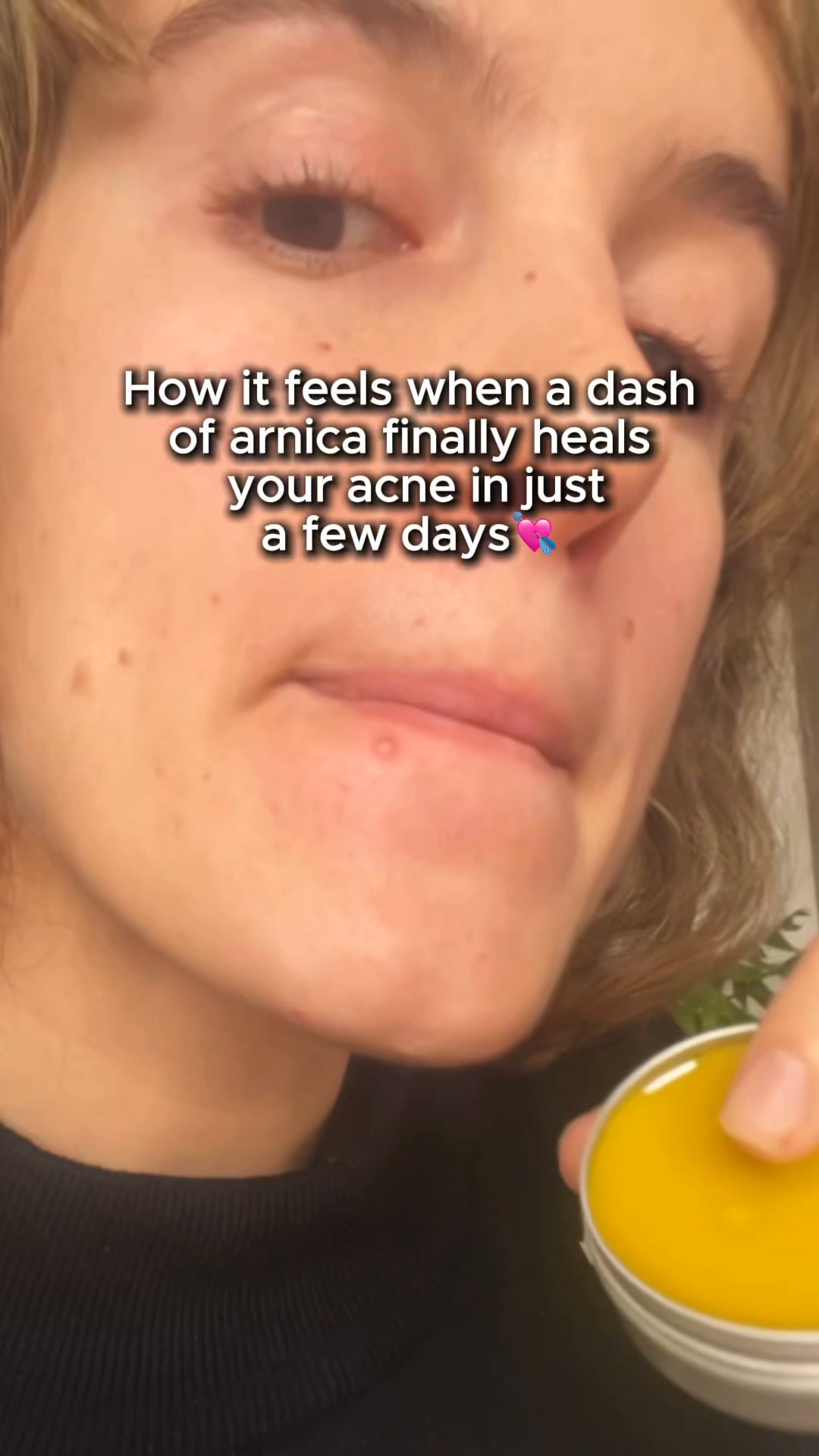 Crazy Results for Acne