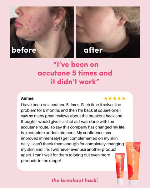 5 Rounds Of Accutane, Still No Fix
