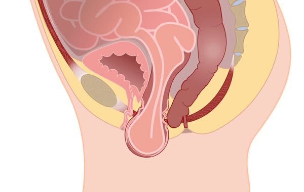 Considering surgery for your prolapse?