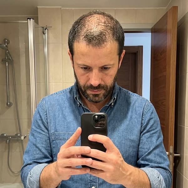 I Was Checking My Hairline 10 Times a Day