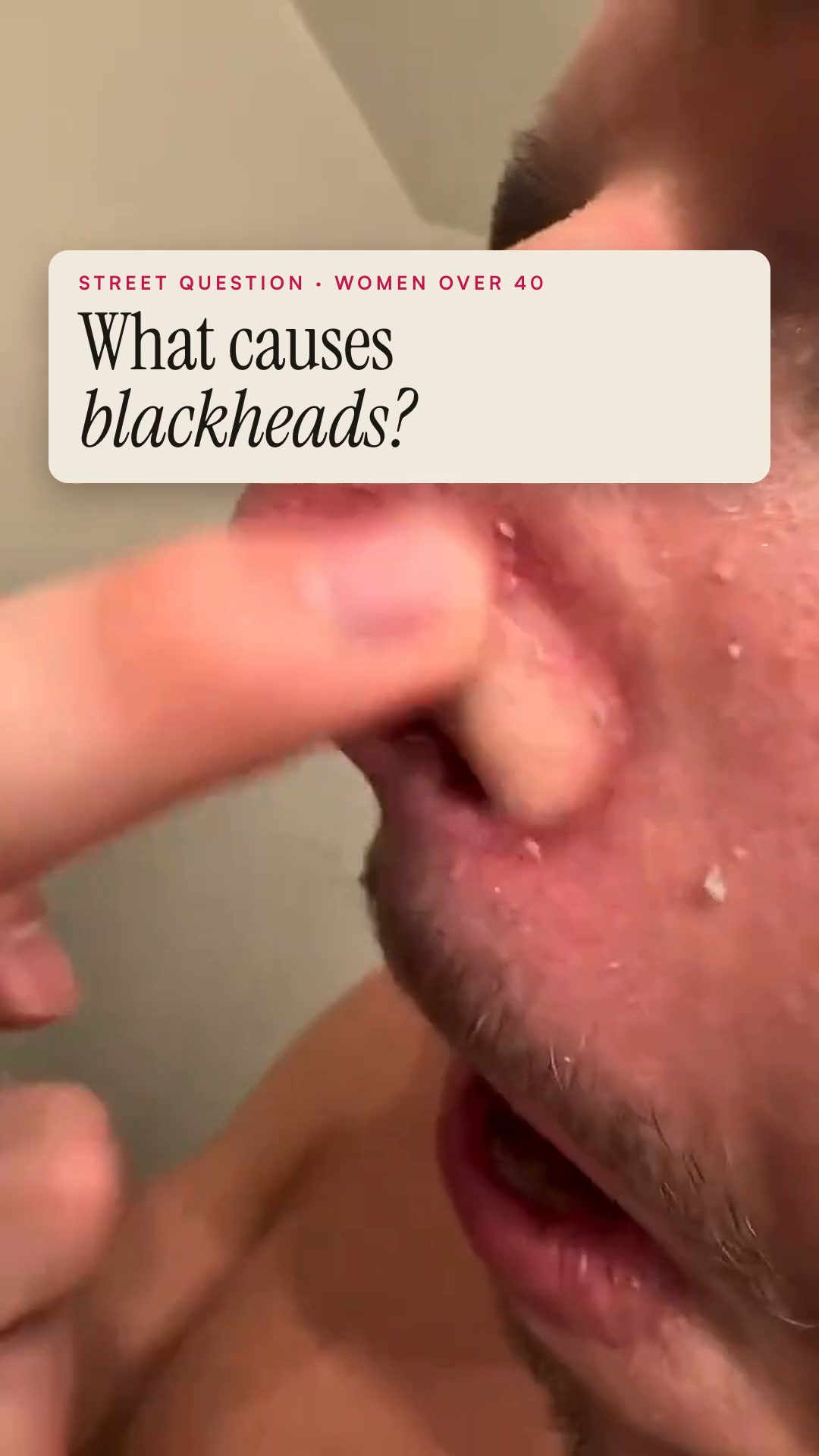 Say goodbye to blackheads