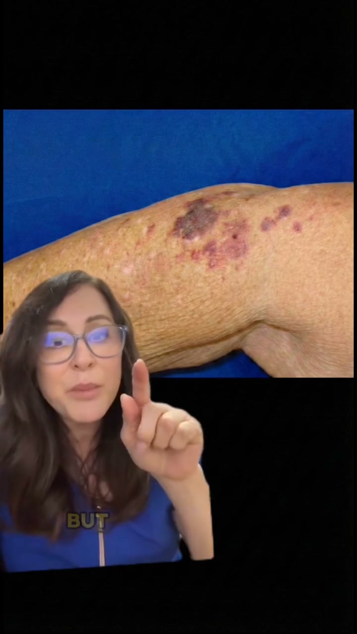 Bruises Gone In Days!