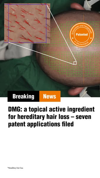 DMG is making headlines in hair loss research
