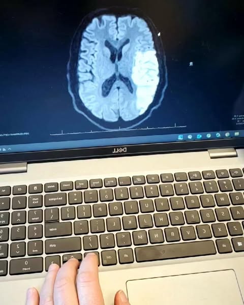 Why Most Stroke Survivors Stop Getting Better