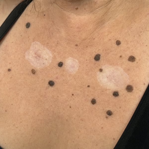 The Reason Your Skin Barnacles Keep Coming Back