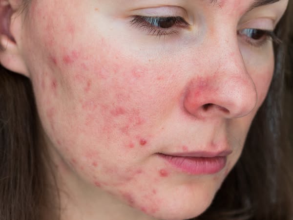 How to Break the Acne Cycle