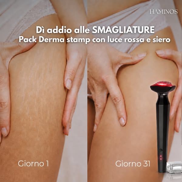 Prenditi cura delle tue smagliature da casa