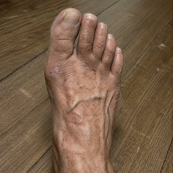 Mi marido ya no podía sentir los pies.