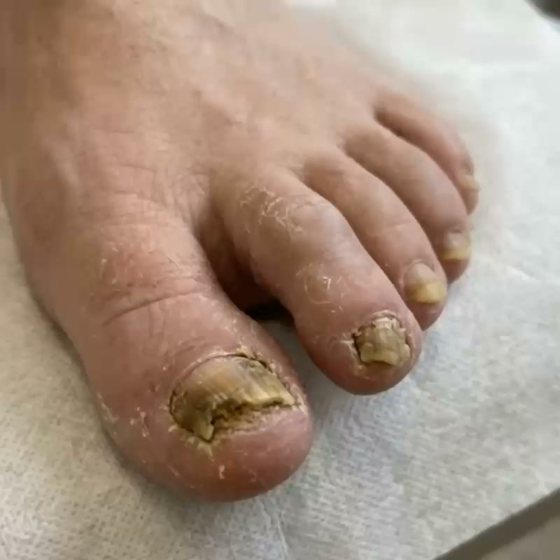Stop Waiting for a GP | Clear Fungal Nails at Home