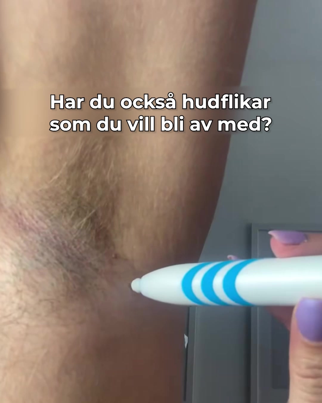 Visste du att du kan ta bort hudflikar hemma?