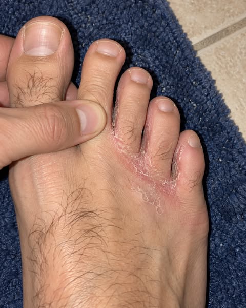 Read This If You Have Athlete's Foot