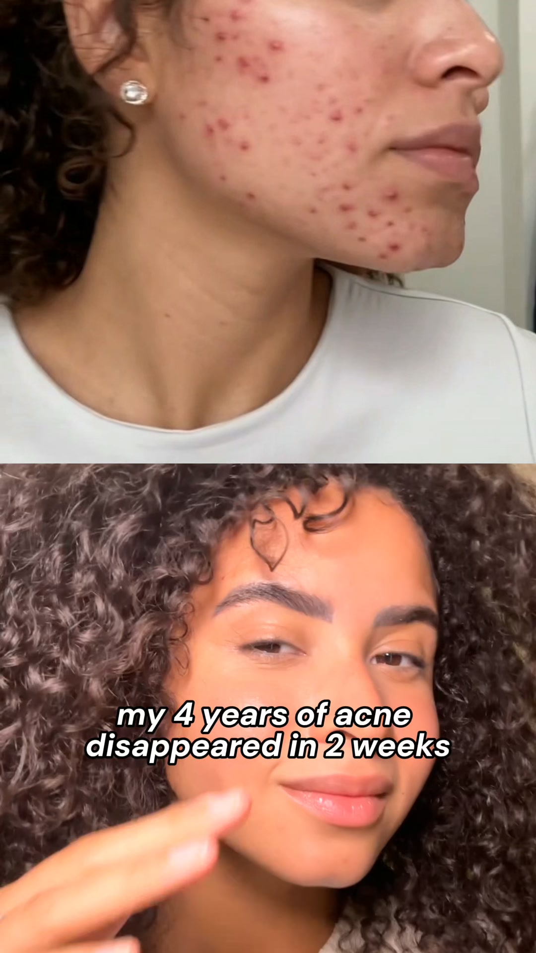 Stop acne now!