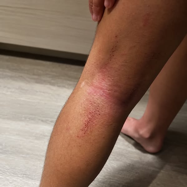 read this if your child has eczema