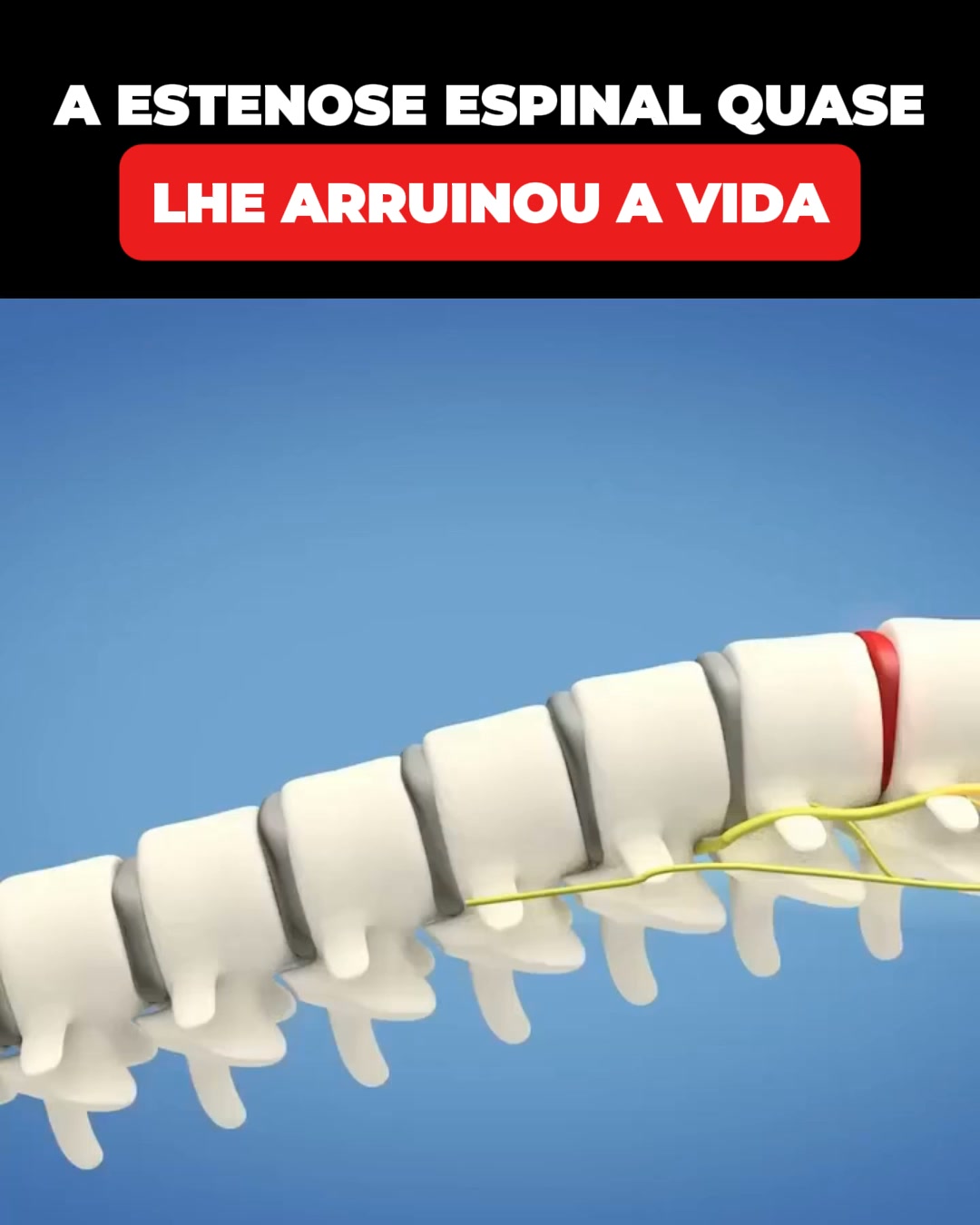 Nova descoberta sobre a estenose espinal