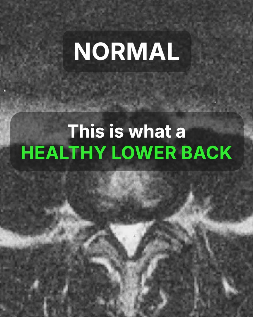 The white streaks on a spinal stenosis MRI