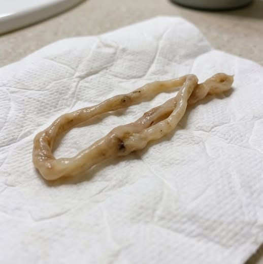 I found the reason why your thyroid weight won't go away...