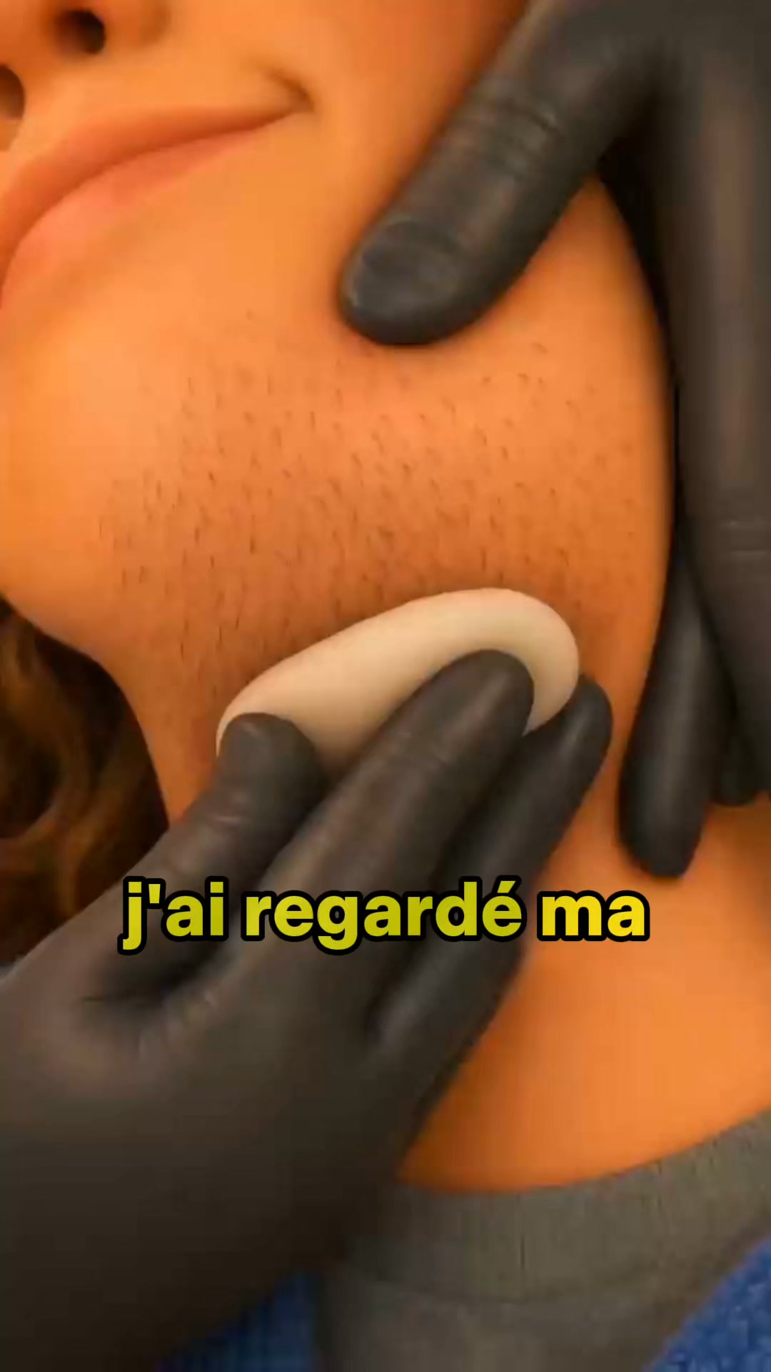 Empêchez vos poils du menton de repousser.
