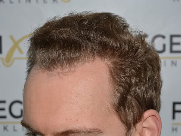 Art Gallery | FueGenix | Hair Restoration Artistry