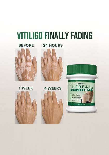 Fast and easy fix for vitiligo.