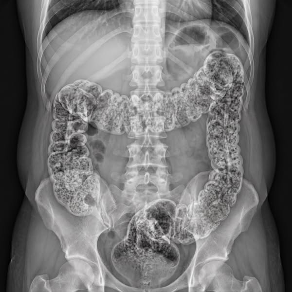 Constipation Due to GLP-1