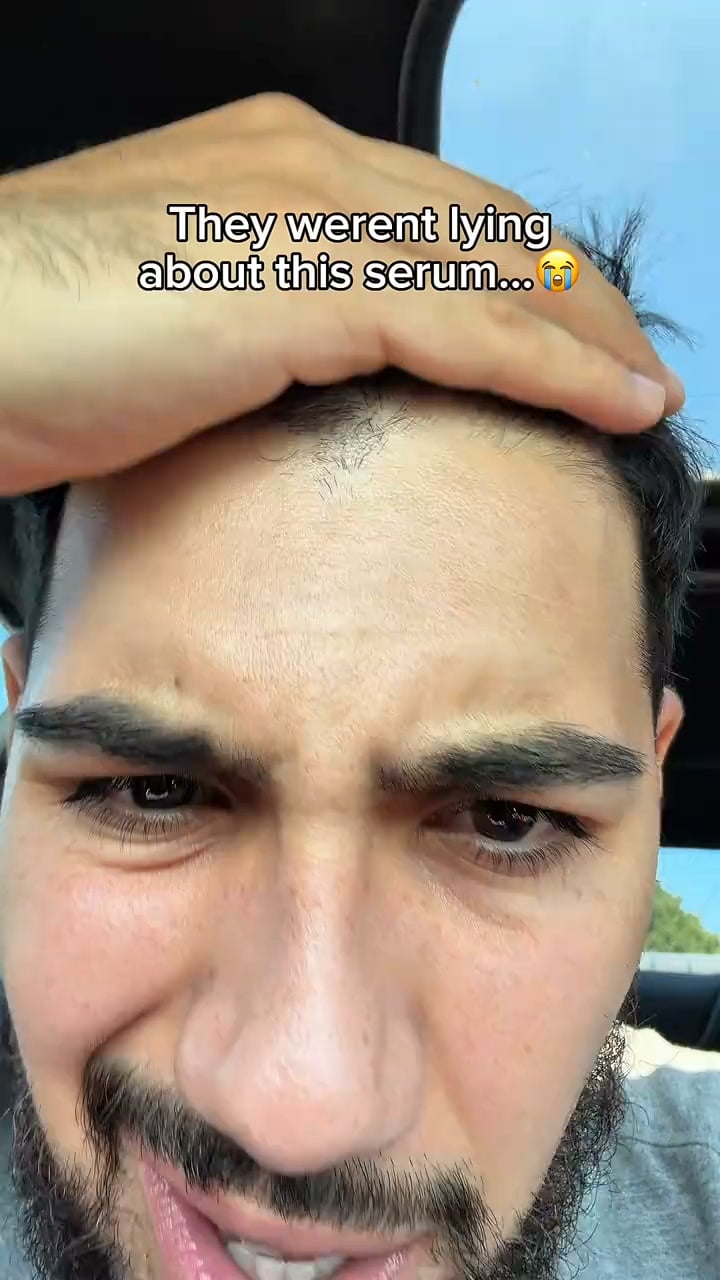 The serum that replaces minoxidil | 70% OFF Today