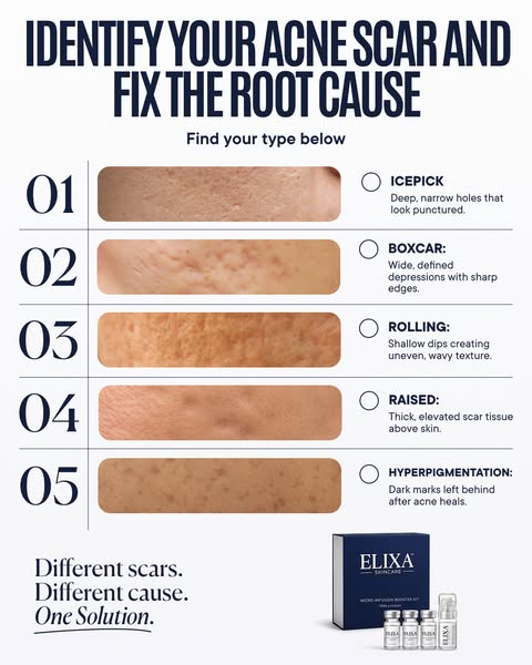 The Ultimate Acne Scar Solution