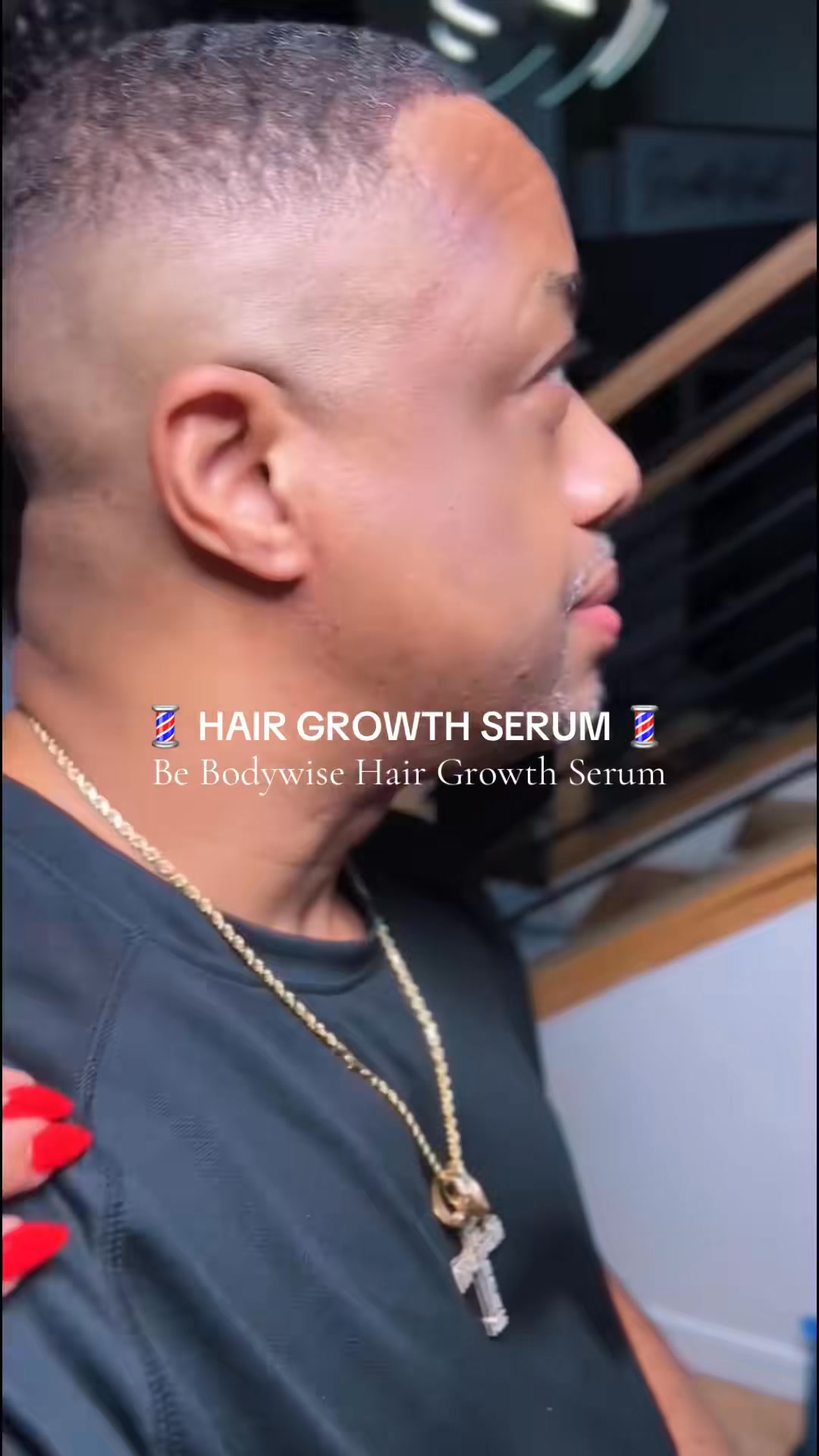 Hair thinning at the crown or temples?