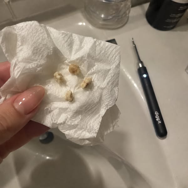 We are all removing tonsil stones wrong.
