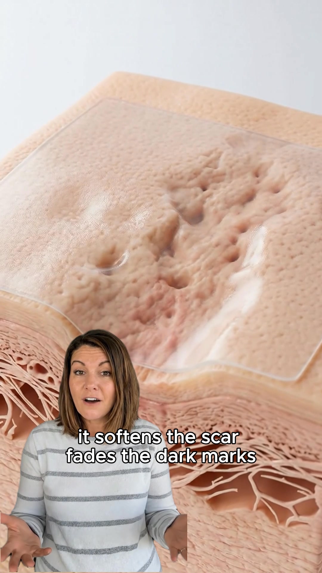 Finally Fade Acne Scars For Good