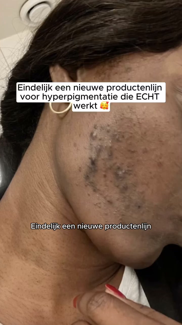 Natuurlijke kracht tegen hardnekkige Pigmentvlekken