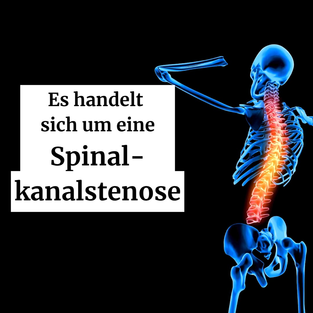 Spinalkanalstenose?