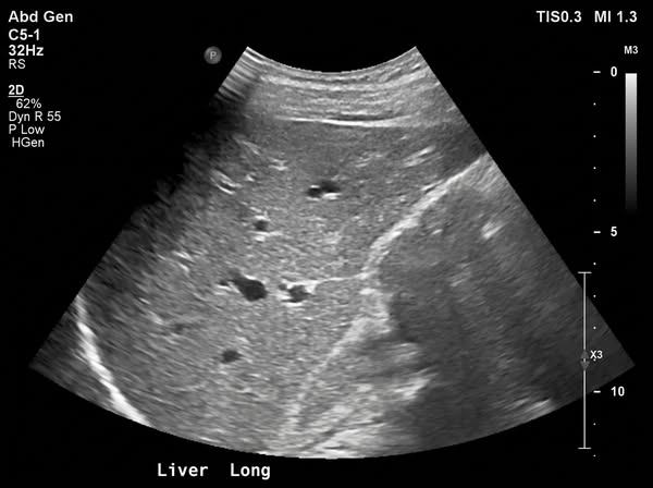 12 questions fatty liver patients ask most.
