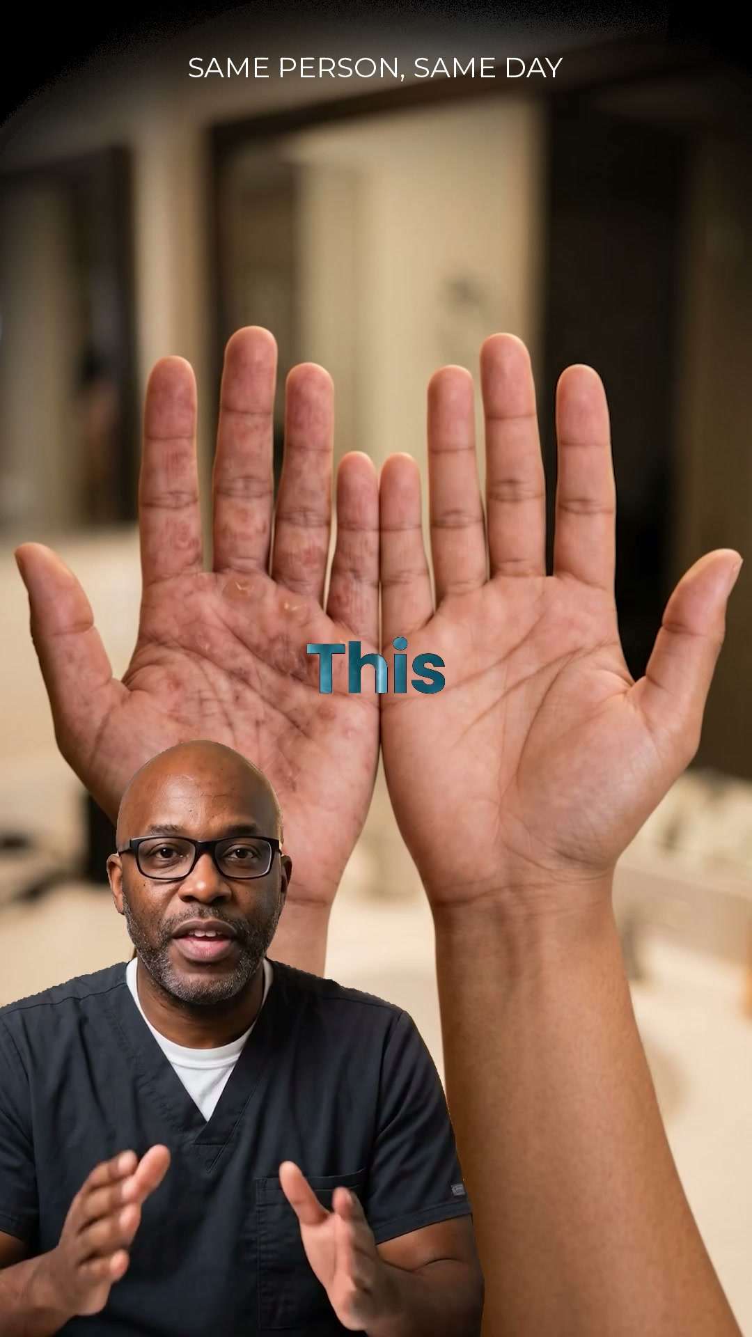 Foot fungus spreads to the hands. Most people do not know this.
