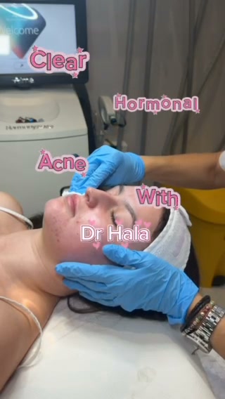 Control Acne