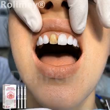 DenPerm Gel harnesses biomimetic 10% Nano-Hydroxyapatite (NH-10) to permanently fill cavities and reconstruct damaged enamel.